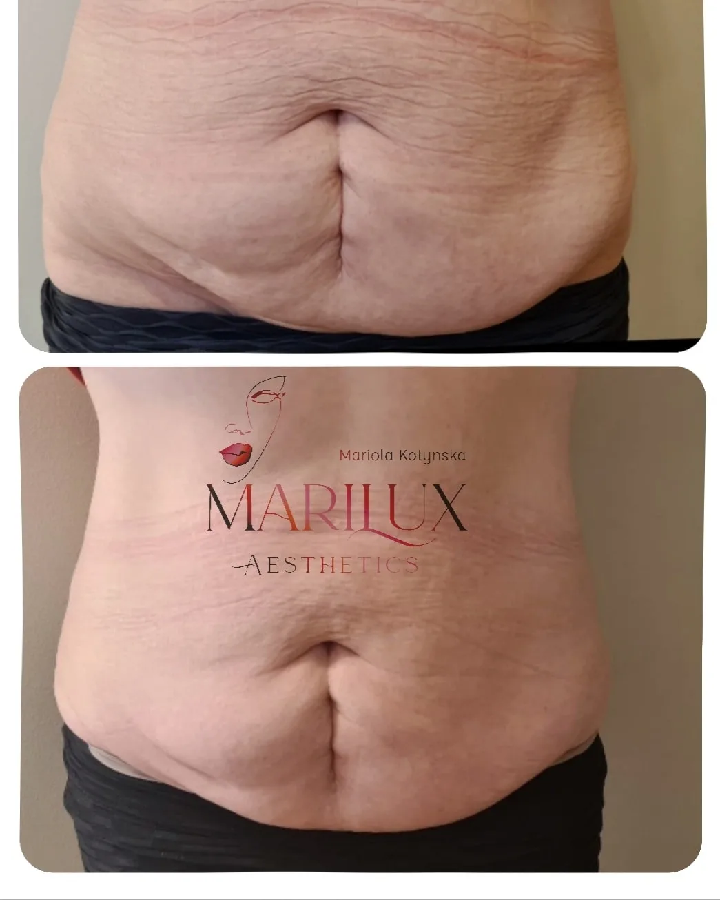 Lipolysis treatment before and after results